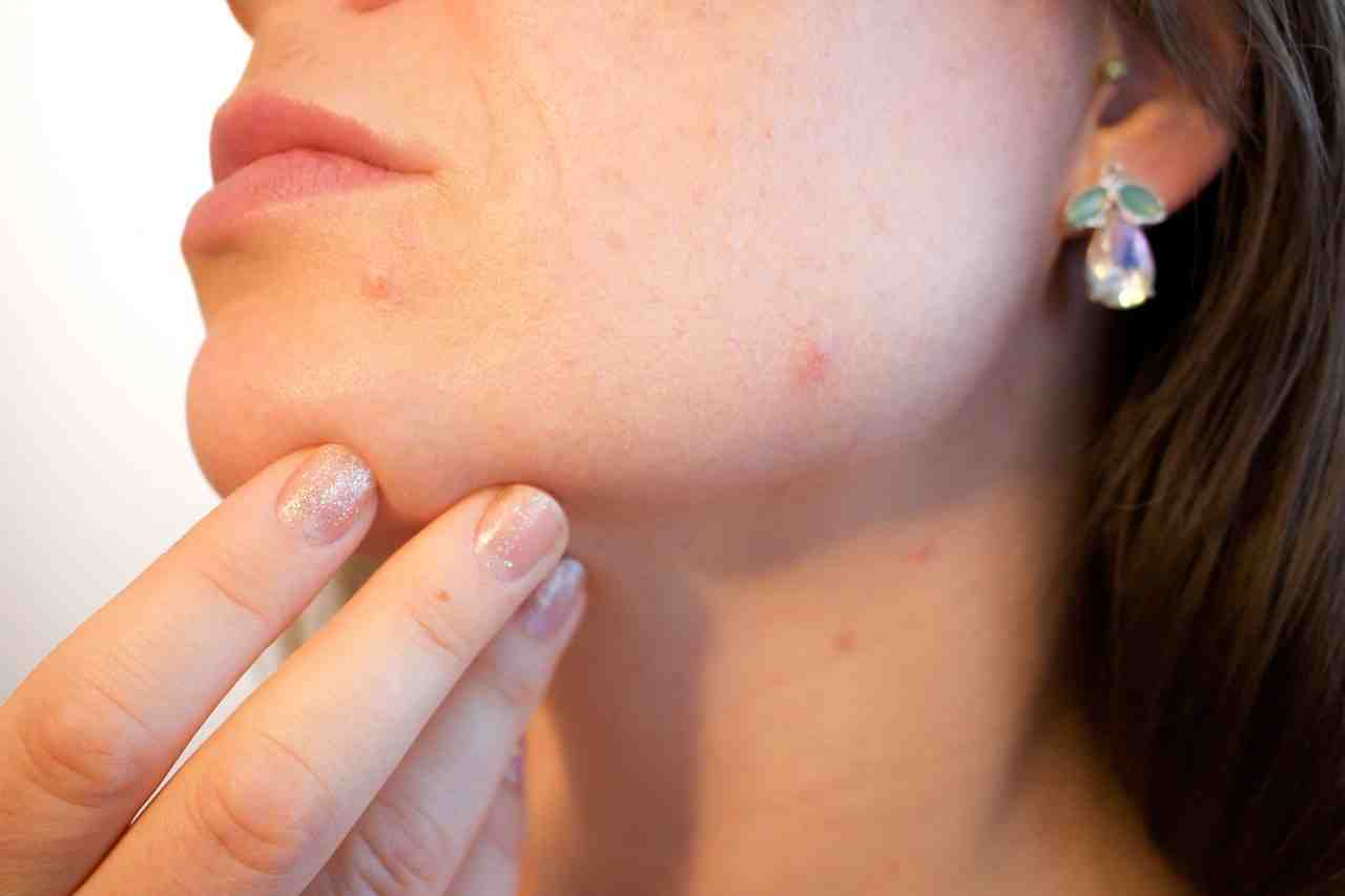 acné, pores, la peau